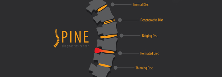 Chiropractic Medina OH Disc Injuries